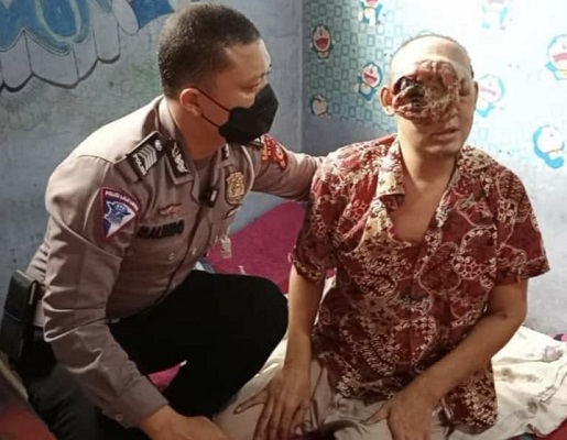 Tumor Ganas Hampir Menutup Semua Wajahnya, Polisi Membantu Carikan Pendonasi